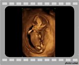 Sonogram 5 Weeks. See more ultrasound - 5 weeks